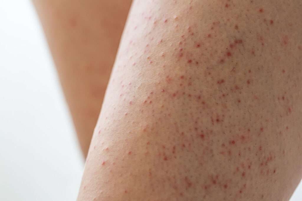 Rough and Bumpy Skin & Keratosis Pilaris Explained