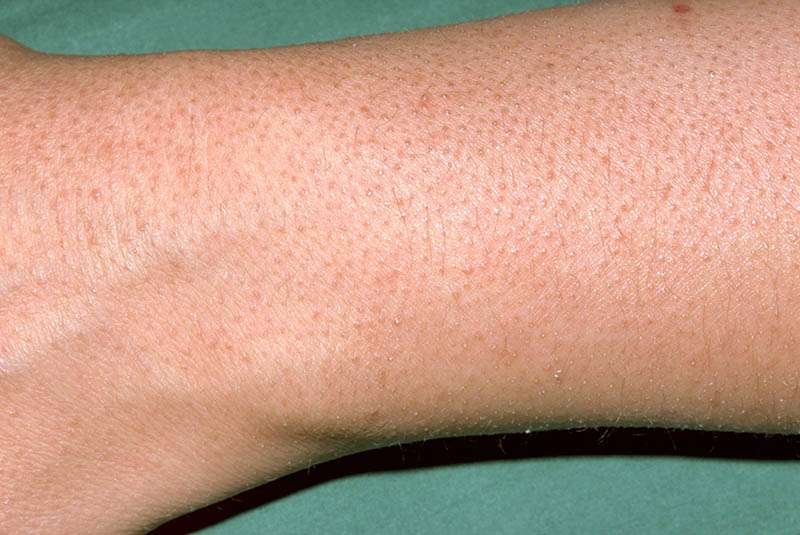 Rough and Bumpy Skin & Keratosis Pilaris Explained