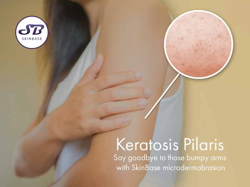 Rough and Bumpy Skin & Keratosis Pilaris Explained